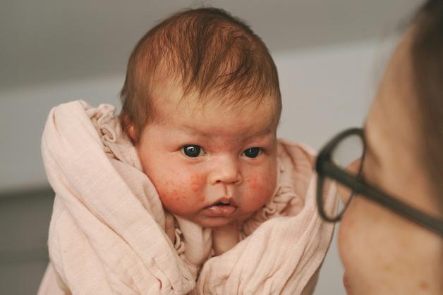 Bébé présentant des rougeurs et des plaques, symptômes fréquents de l'eczema bébé.